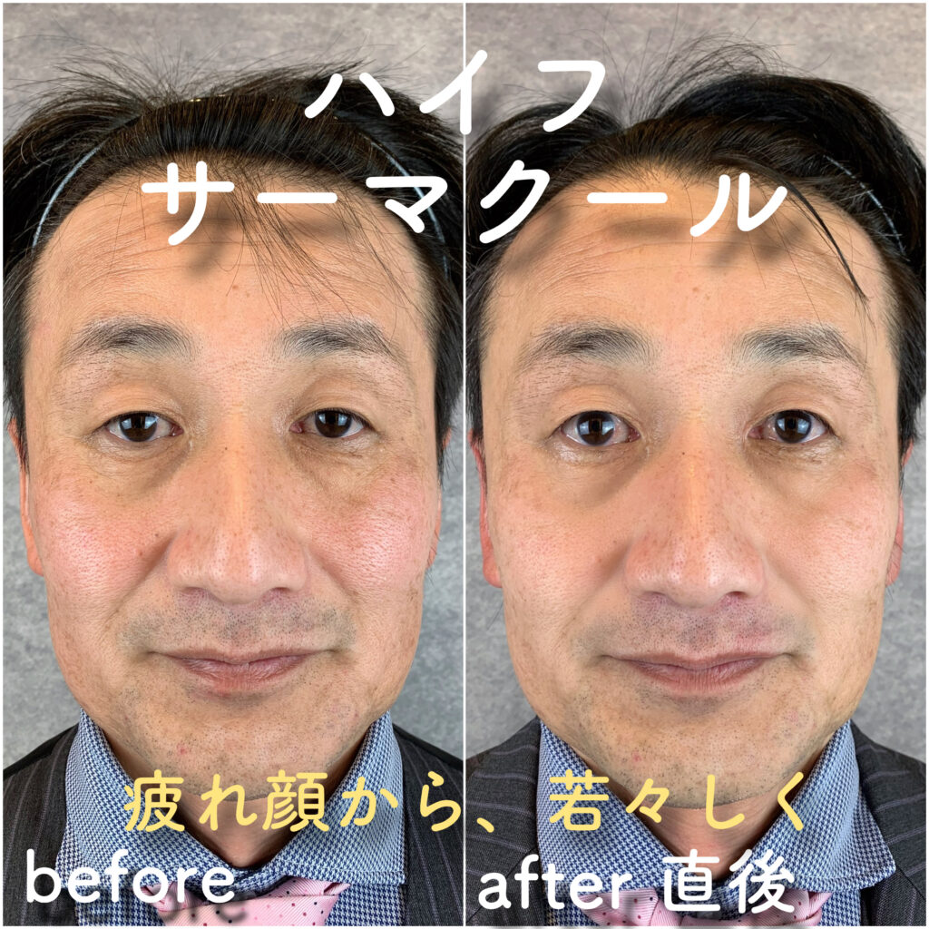 ビフォーアフター