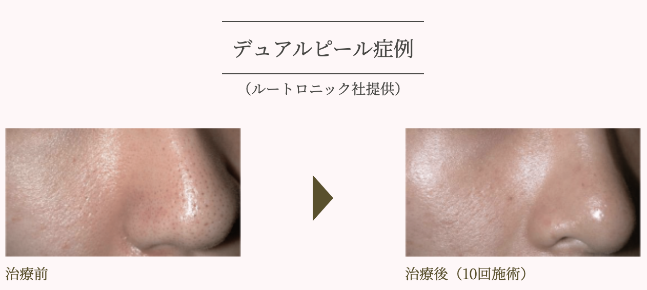 ルートロニック社提供スペクトラピールの症例写真