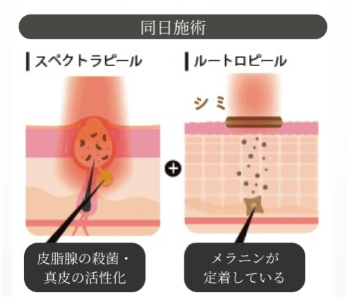 ルートロニック社提供スペクトラピールとルートロピールの効果イメージ
