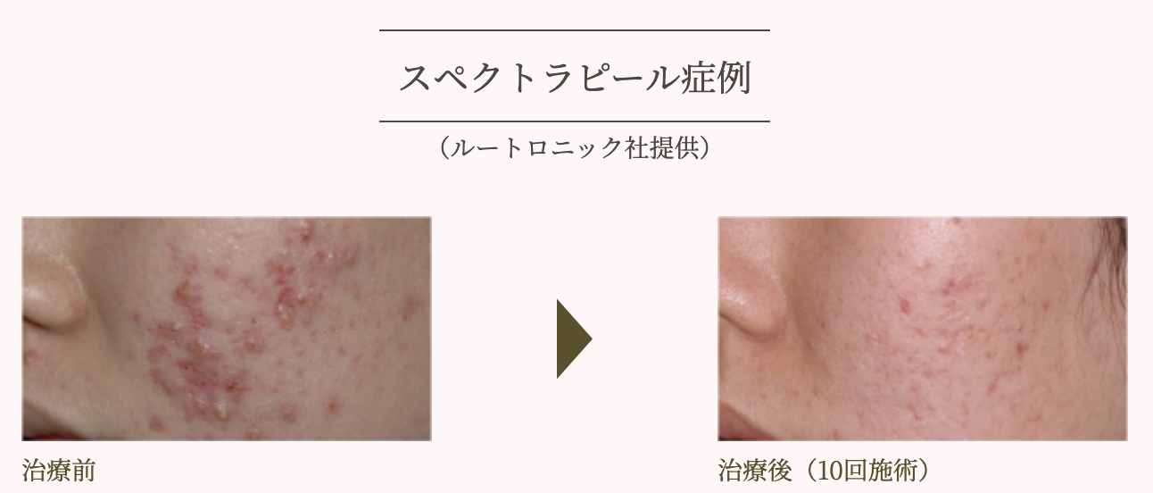 ルートロニック社提供スペクトラピールの症例写真