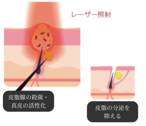 ルートロニック社提供スペクトラピールの照射イメージ
