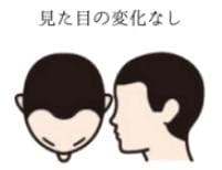 薄毛の進行度1
