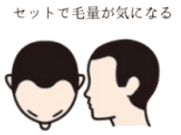薄毛の進行度2