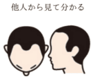 薄毛の進行度3