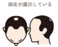 薄毛の進行度4