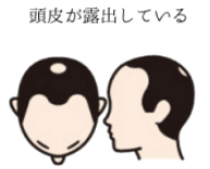 頭皮が露出している