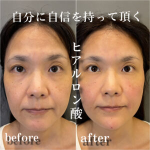 30代から始めるほうれい線対策！ヒアルロン酸の効果的な使い方と選び方