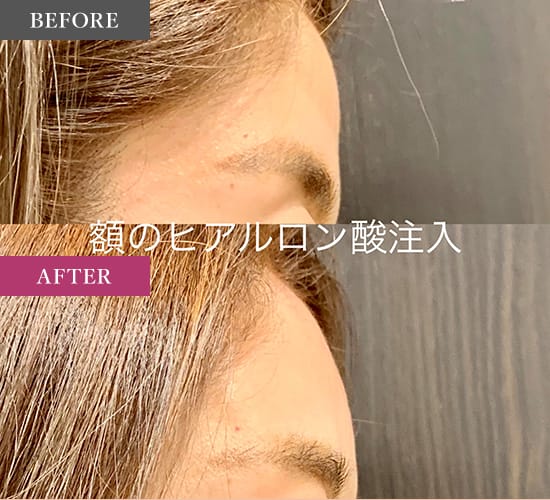ルラ美容クリニックのボトックス症例