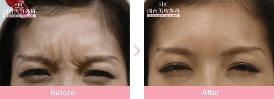 湘南美容クリニックおでこのヒアルロン酸症例