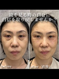 ヒアルロン酸注入No.10498