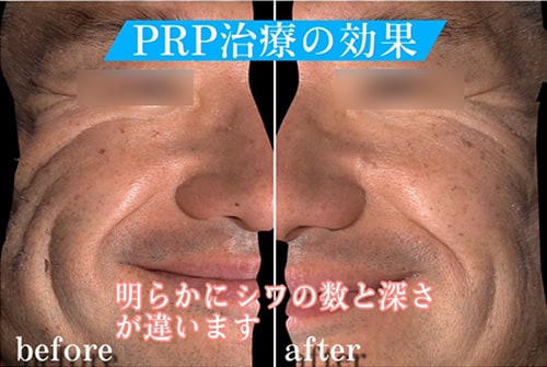 PRP治療のビフォーアフター