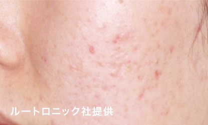 スペクトラピール