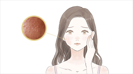 めんぽう、白ニキビ
