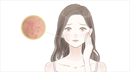 炎症性のニキビ