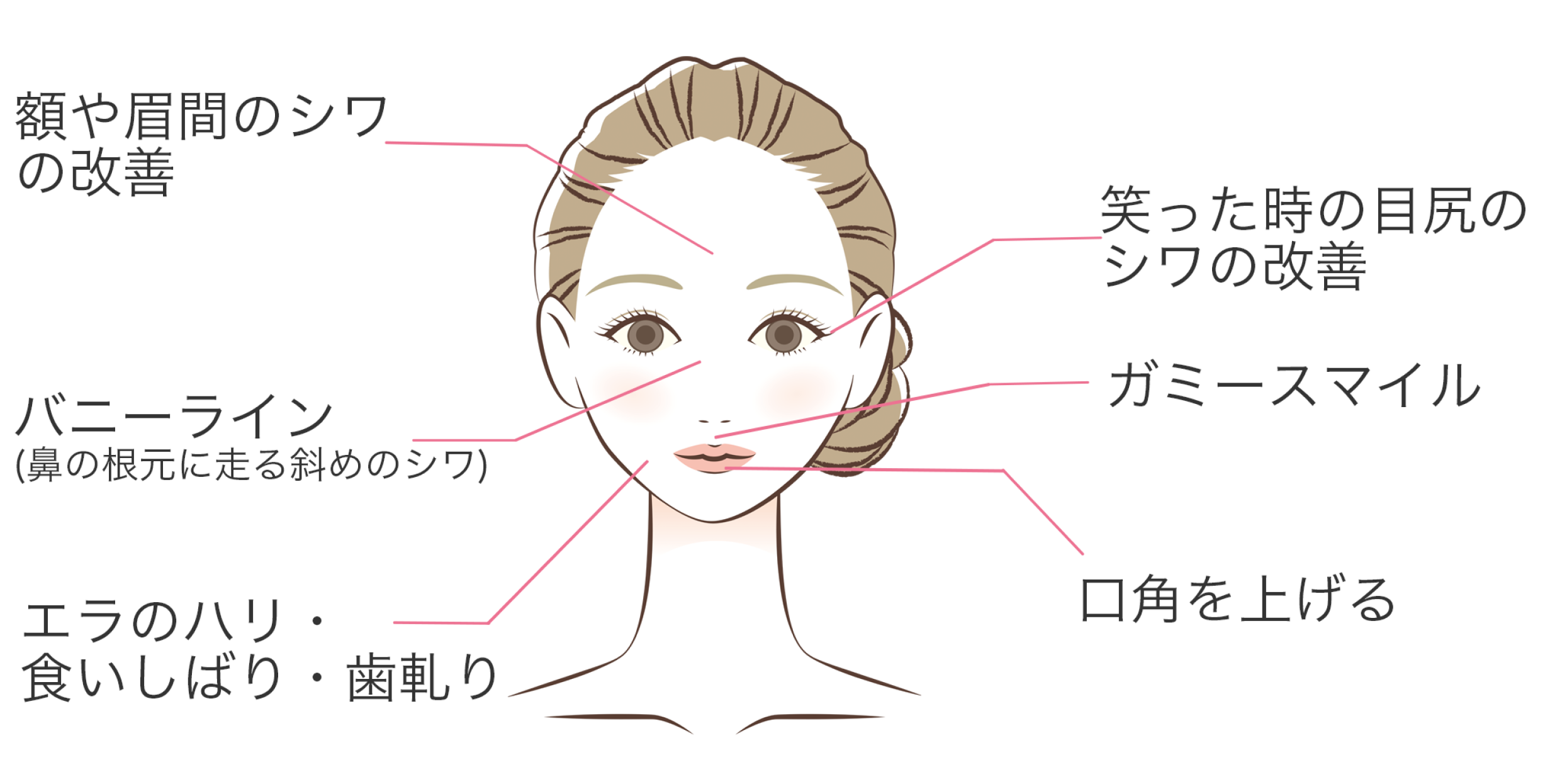 ボトックス注入の効果