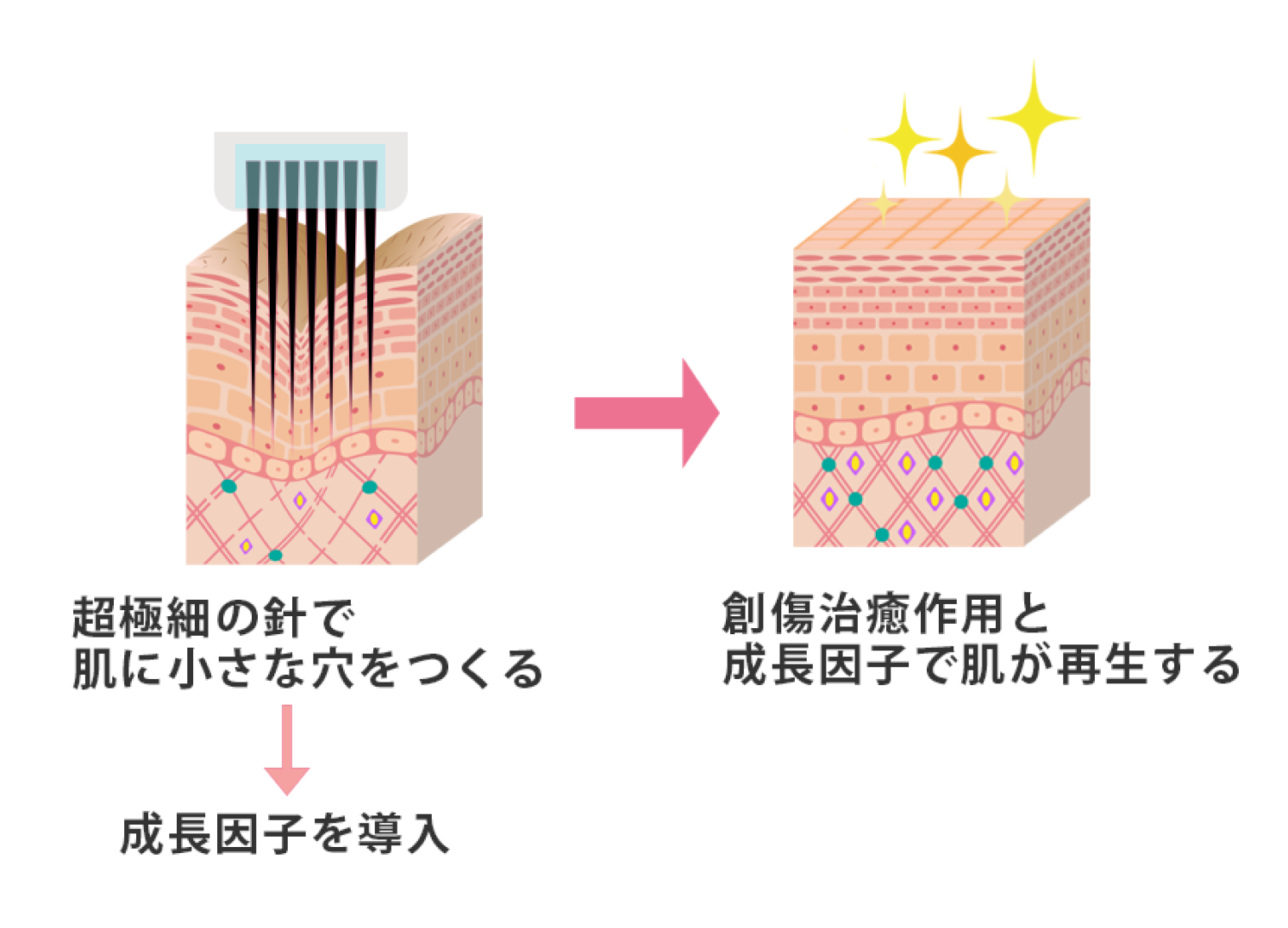 ダーマペンの効果