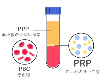 PRP療法とは