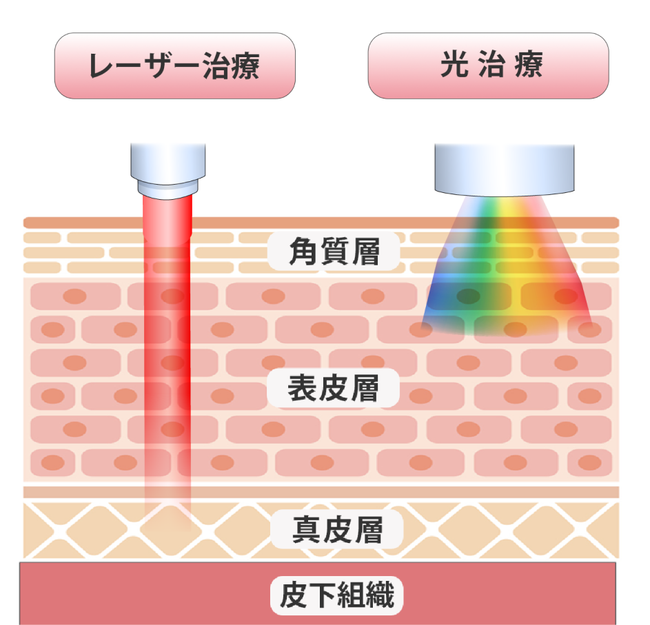 レーザートーニングとフォトシルクの違い