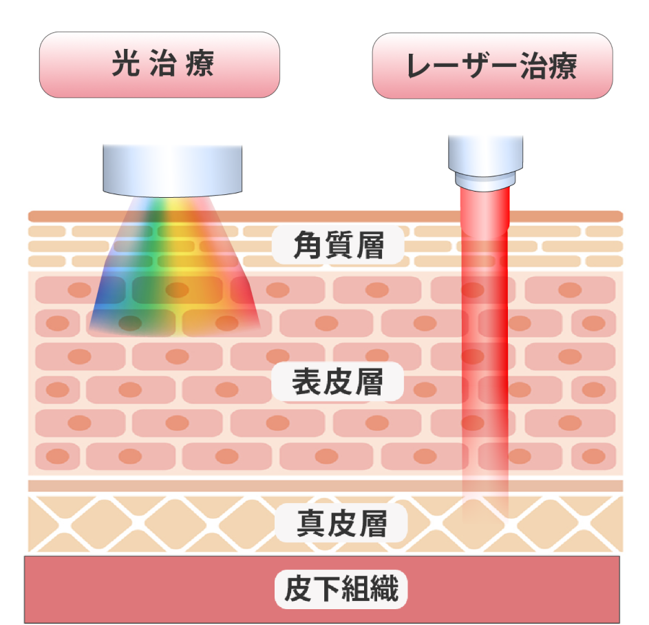 レーザートーニングとフォトシルクの違い