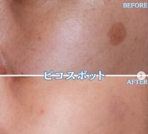 MYビューティクリニックシミ取り症例写真
