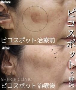 シェリークリニックシミ取り症例写真