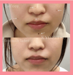 共立美容外科ほくろ除去東京症例写真