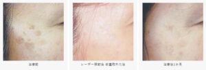 銀座よしえクリニックシミ取り症例写真