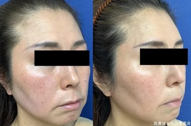 銀座よしえクリニックおでこのヒアルロン酸症例写真