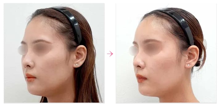 水の森美容クリニックヒアルロン酸症例写真