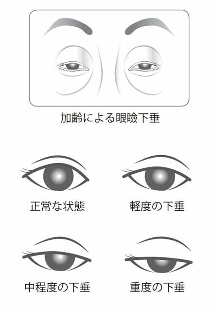 おでこに深いしわができる原因 眼瞼下垂症によるもの