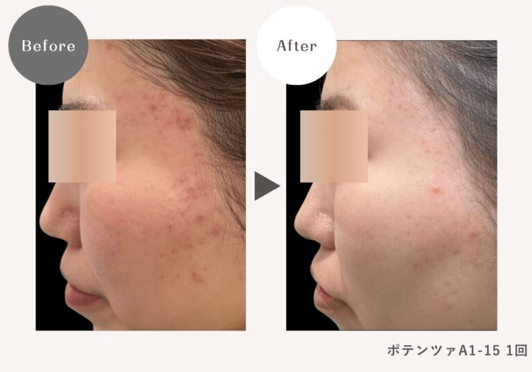 DAILY SKIN CLINIC 福岡院-ポテンツァ症例写真
