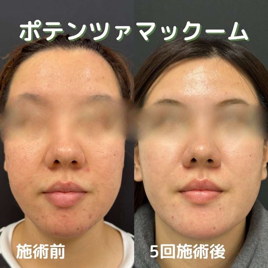 ルラ美容クリニック福岡院-ポテンツァ症例写真